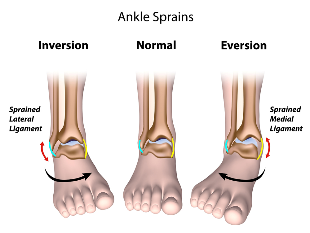 Types of ankle sprains