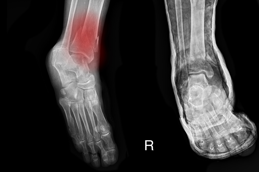 closed fracture tibia right leg