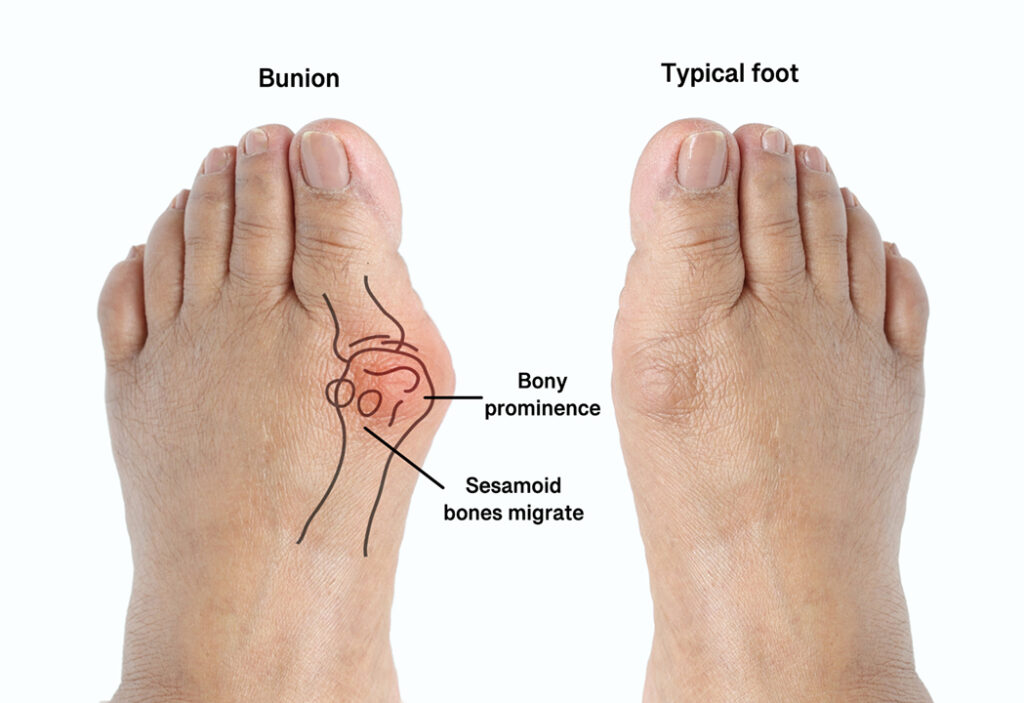 Bunion vs normal foot